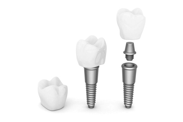 Making Your Implant Crowns Last